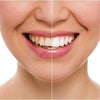 20 Minute Dental Teeth Whitening Kit
